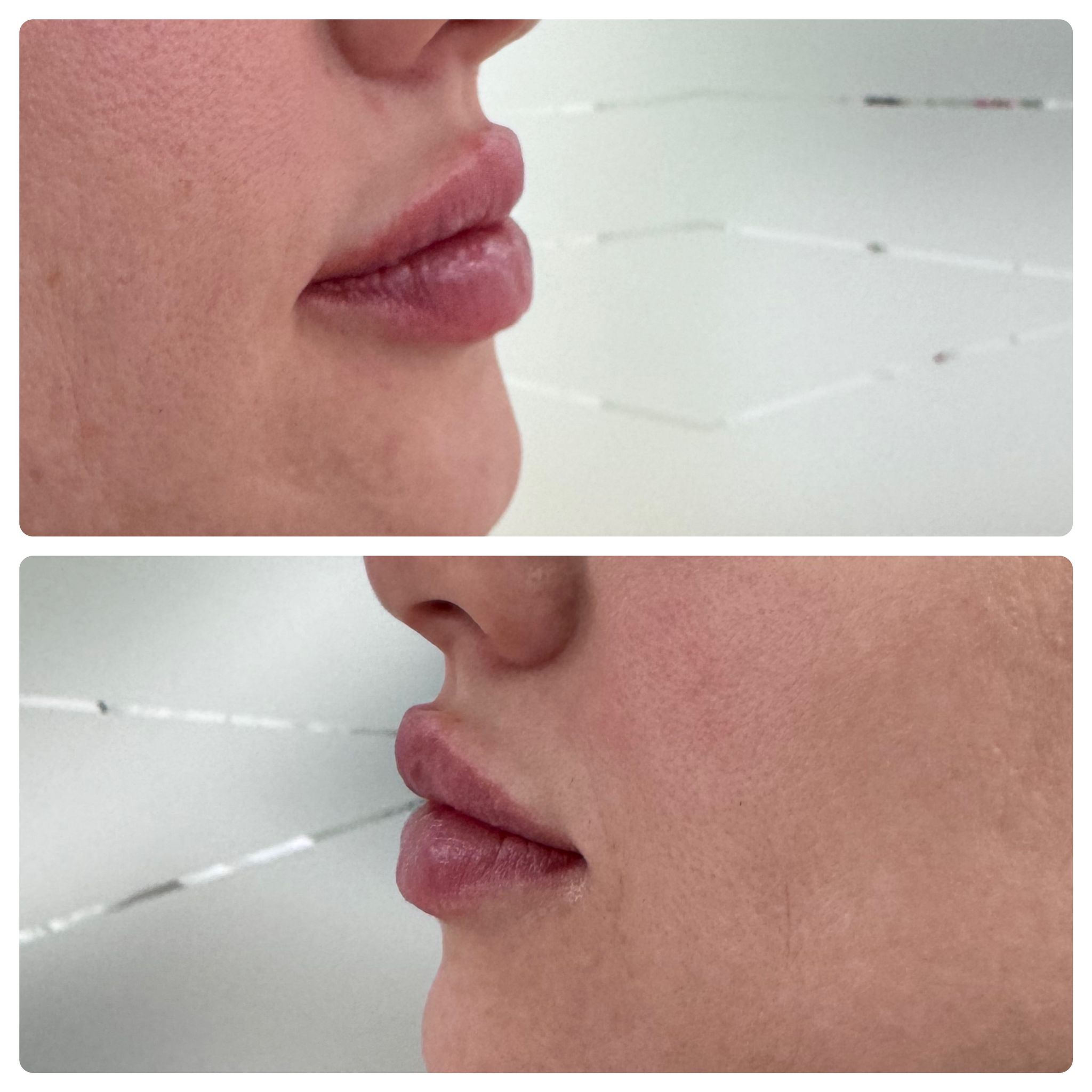 lip-filler-01-16-24.jpg