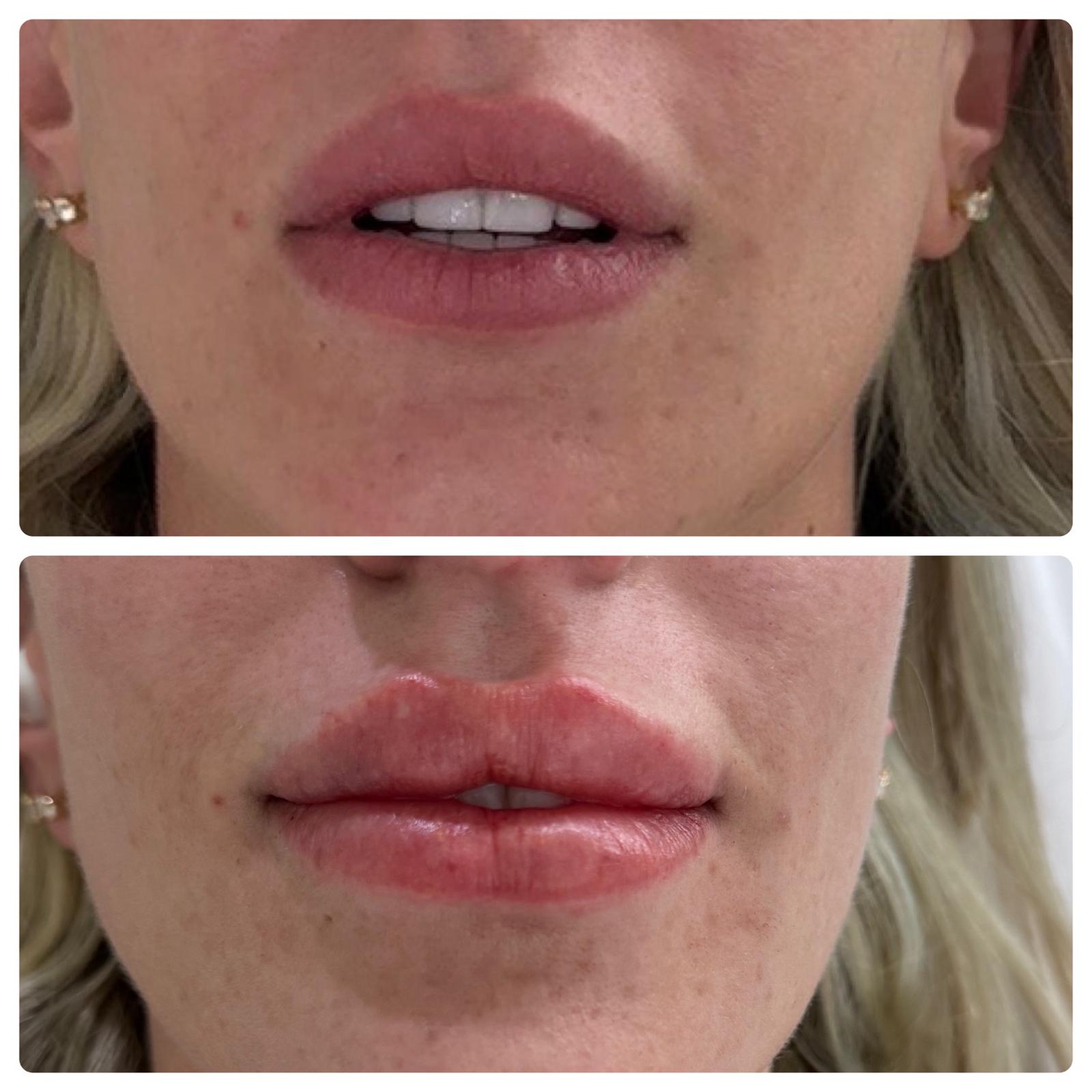 lip-filler-01-29-24.jpg