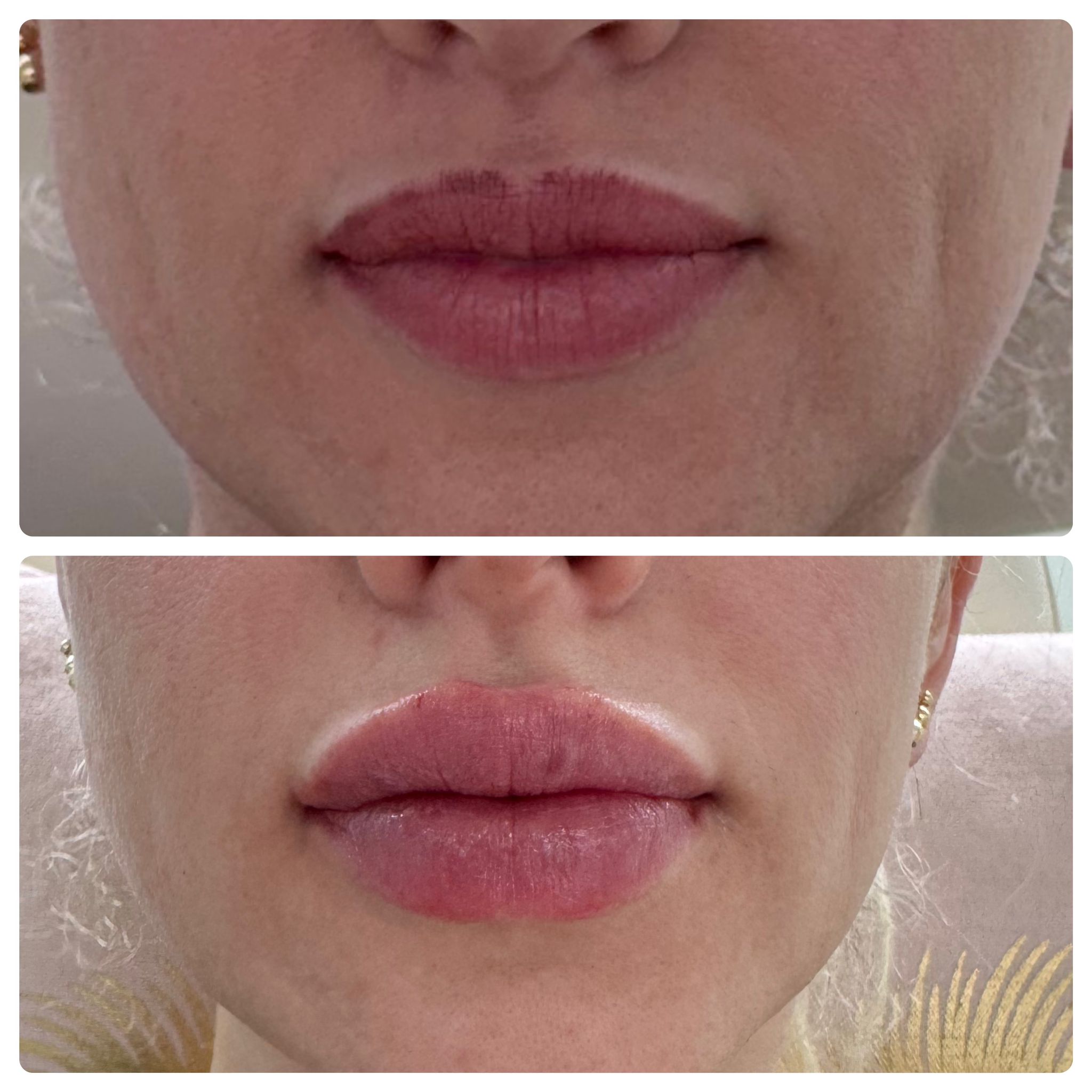 lip-filler-1-19-2024.jpg